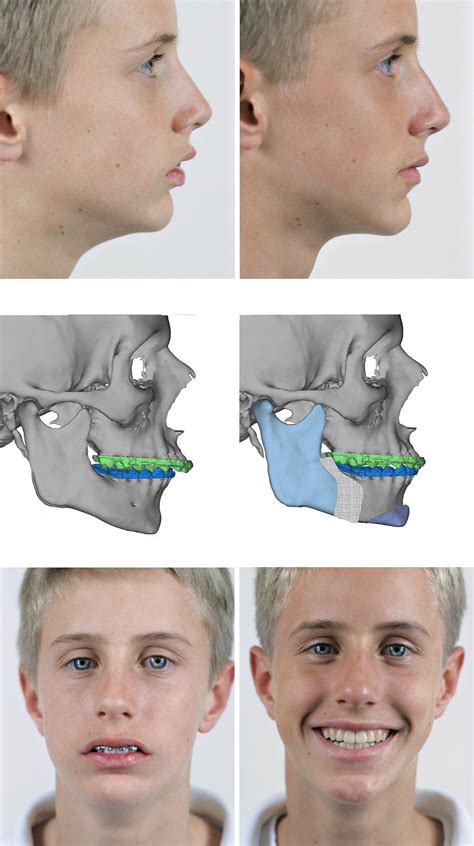 fixing plates after corrective jaw surgery